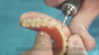 Smart Way to Convert a Denture to Fixed Implant Prosthesis