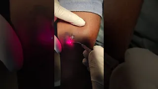 PERMANENT TATTOO REMOVAL WITH LASER