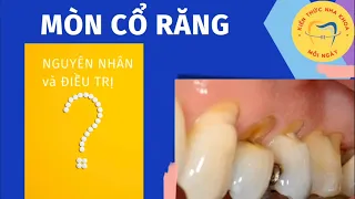 Mòn cổ răng 🦷 | Kiến thức nha khoa | Dấu hiệu và phòng ngừa.