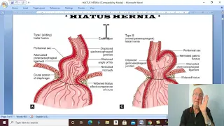 Esophageal disorders in Arabic 6 ( Hiatus hernia, part 1  ) , by Dr. Wahdan.