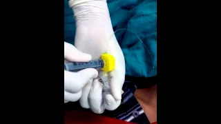 Technique for opening epidural connector