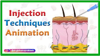 Injection Techniques Animation : Intradermal, Intramuscular, Subcutaneous and Z track