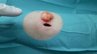 Хирургическое удаление липомы при липоматозе на руке