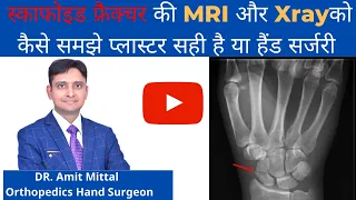 Scaphoid Fracture in hindi | टूटी ही कलाई की हड्डी के XRAY और MRI को कैसे समझे |  स्केफोइड फ्रैक्चर