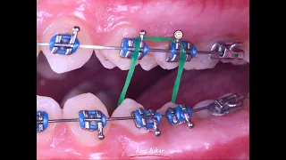 Scissor bite correction in orthodontics by cross elastic band