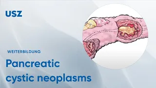 Pancreatic cystic neoplasms – Please participate in our 3-minute survey below!