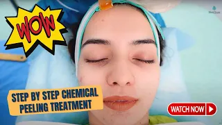 Step by Step Chemical peeling treatment | Peeling Treatment in Delhi | Dr Jangid | SkinQure | Delhi