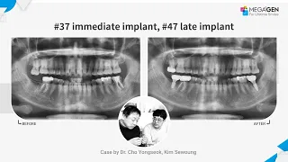 Dr. Yongseok CHO, Sewoung KIM, #37 immediate #47 late implnat surgery and prosthesis