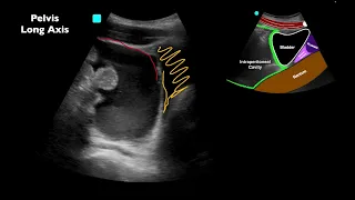 POCUS: Positive E-FAST after MVC - Can you identify all of the findings?