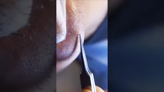 ingrown hair pull out speedx2 with tweezers!  Satisfying 242 #shorts #satisfying  #well  #removal