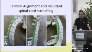 Management of Cervical Stenosis: Anterior vs Posterior Approaches by Charles Sansur, M.D.