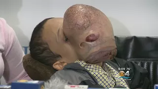 Teen With 10-Pound Tumor On Face Dies In Hospital