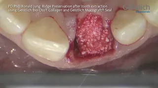 PD PhD Ronald Jung: Ridge Preservation after Tooth Extraction using Geistlich Mucograft® Seal