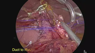 Laparoscopic modified Blumgart pancreaticojejunostomy