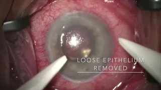 Surgical video of DSEK corneal transplant to treat advanced/severe corneal oedema