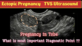 Ectopic Pregnancy  | TVS Ultrasound | what is Diagnostic Point