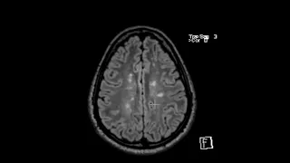 Multiple sclerosis