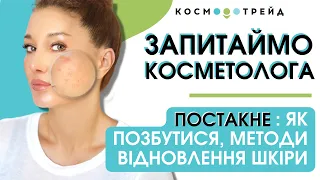 Запитаймо косметолога: Як позбутися пост акне? Огляд процедур для відновлення шкіри обличчя