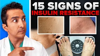 15 Signs Of Insulin Resistance You Should Look Out!