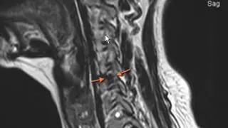 Typical disc herniation of cervical spine