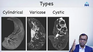 CT imaging and diagnosis of Bronchiectasis