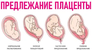 ПЛАЦЕНТА ВО ВРЕМЯ БЕРЕМЕННОСТИ | Чем опасно полное предлежание плаценты при беременности