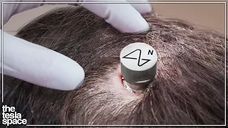 Neuralink Begins Human Trials!