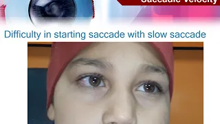 1-4 Motor evaluation of strabismus: Non-comitant strabismus - Paralytic vs. Restrictive