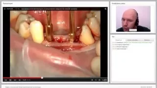 2015 08 11 Видео и клинический случай одномоментной имплантации