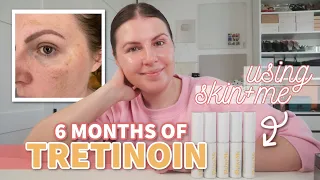 TRETINOIN EXPERIENCE / 6 month SKIN + ME  Review - Does it Work For PIGMENTATION? // BEFORE/AFTER