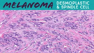 Melanoma (combined desmoplastic and spindle cell types) (AIP France 2021 - case 9)