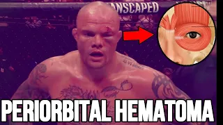Doctor Reacts to Anthony Smith Nasty Orbital Injury: UFC SIngapore