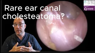 Rare ear canal cholesteatoma? - Episode 86 #earwaxremoval #ear #earwax