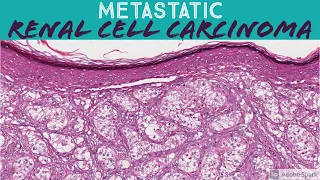 Metastatic Renal Cell Carcinoma (RCC) in Skin: 5-Minute Pathology Pearls