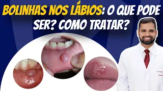 Bolinhas nos lábios: O que pode ser? Como tratar? #herpesvirus #candidíase #sapinho #hiperplasia