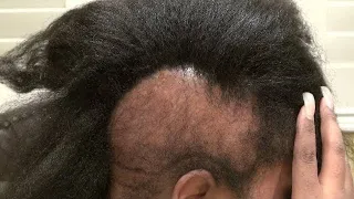 THIS IS WHY BLACK WOMEN ARE BALD | Genetics, Self hate, identity | REUPLOAD