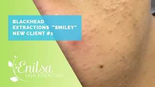 Blackhead Extractions "Smiley" New Client #1