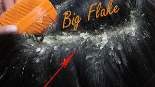 Itchy Dry Scalp!! Dandruff Scratching And Picking Satisfying!! Removal A Big Dandruff From Hair