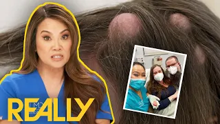 Dr Lee Amazed By Head Cysts With 'Beards' | Dr Pimple Popper