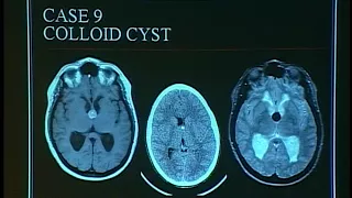 Neuroradiology with head and neck  lecture