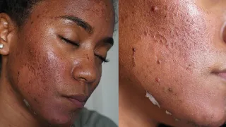 GREEN PEEL Full Process { Procedure, Peeling, Before & After} *NO CHEMICAL PEEL*