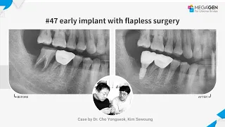 Dr. Yongseok CHO, Sewoung KIM, #47 early implant with flapless surgery and prosthesis