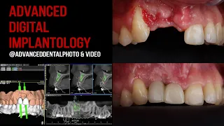 Имплантация центральных зубов после ДТП Mis implants - connect abutment - IDR Dziuba implant studio