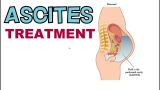 HOW TO TREAT ASCITES FAST! ASCITES TREATMENT OPTIONS