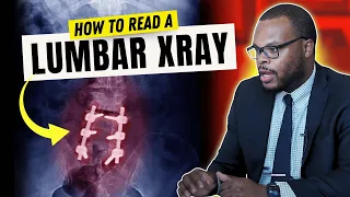 How to Read a Lumbar Xray
