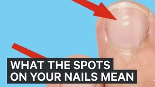 What white marks on nails mean about health #ai nails #shortsvideo #instagram