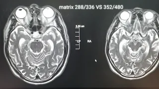 MRI matrix size(pixel) _Image comparison according to pixel size