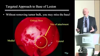 Management of Inverted Papilloma by Andrew Goldberg, MD