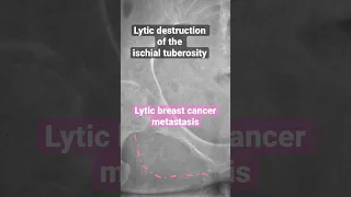 Osseous metastasis from Breast Cancer #radiology #breastcancer  #cancer