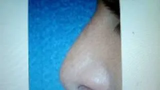 rhinoplasty,septoplasty,nose job,qatar,  جراحة  تجميل المنخارتجميل الانف